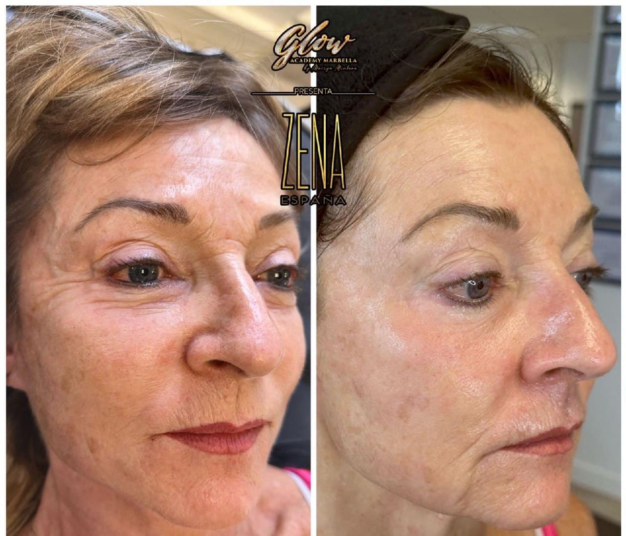 Vorher-und-Nachher-Behandlungsbeispiel aus der Grundaufbau-Praxis – Gesicht in seitlicher Ansicht